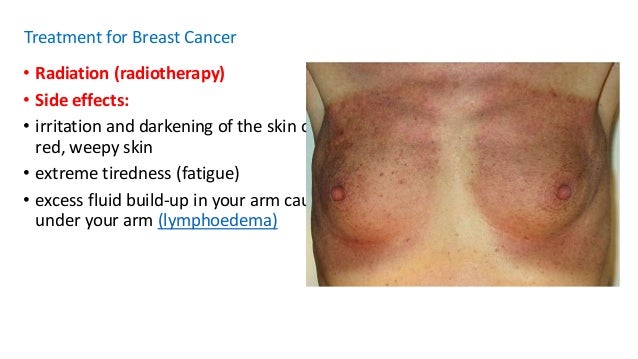 breast cancer radiation therapy side effects Taboo xxx bbs